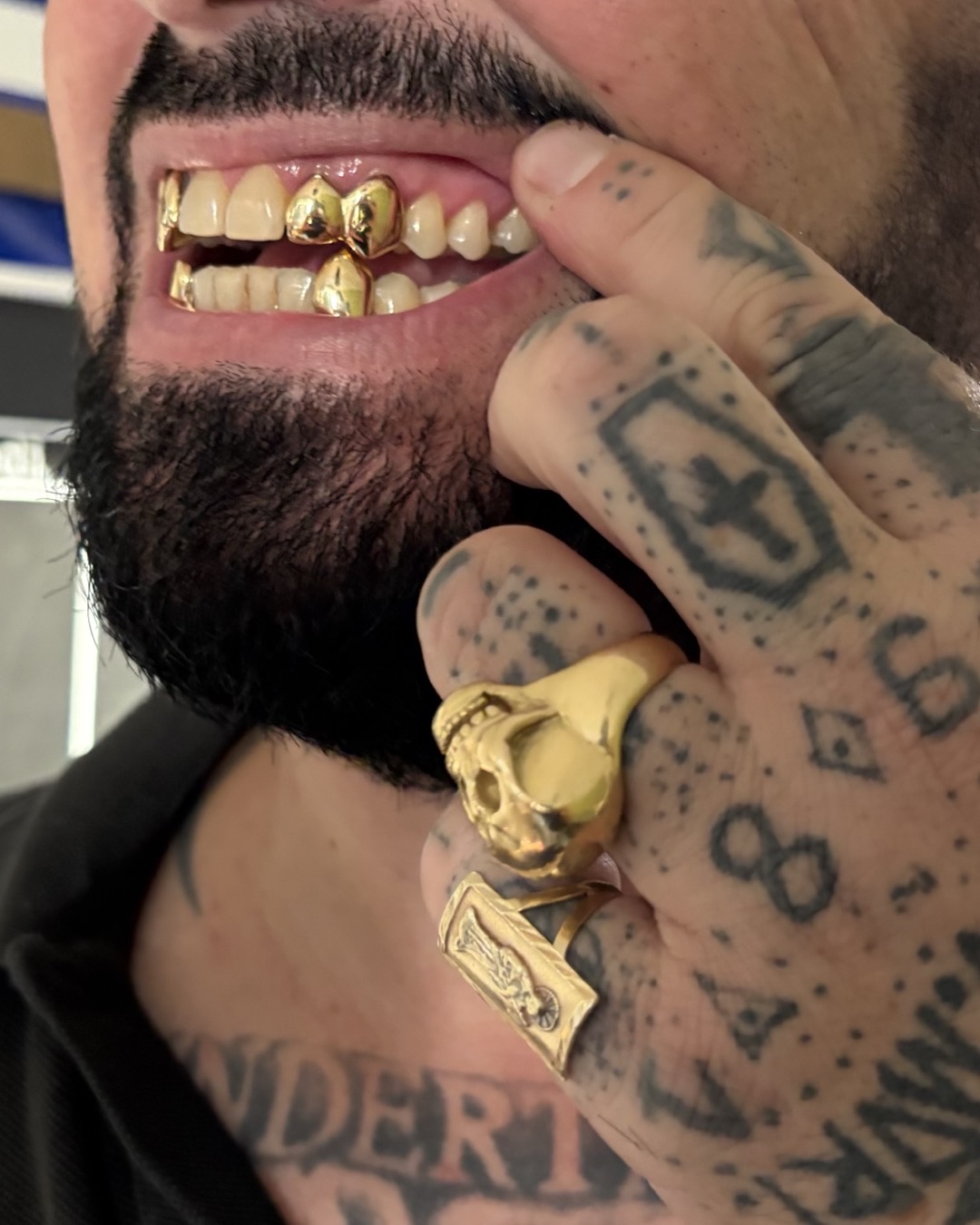 Grillz en or sur plusieurs dents
