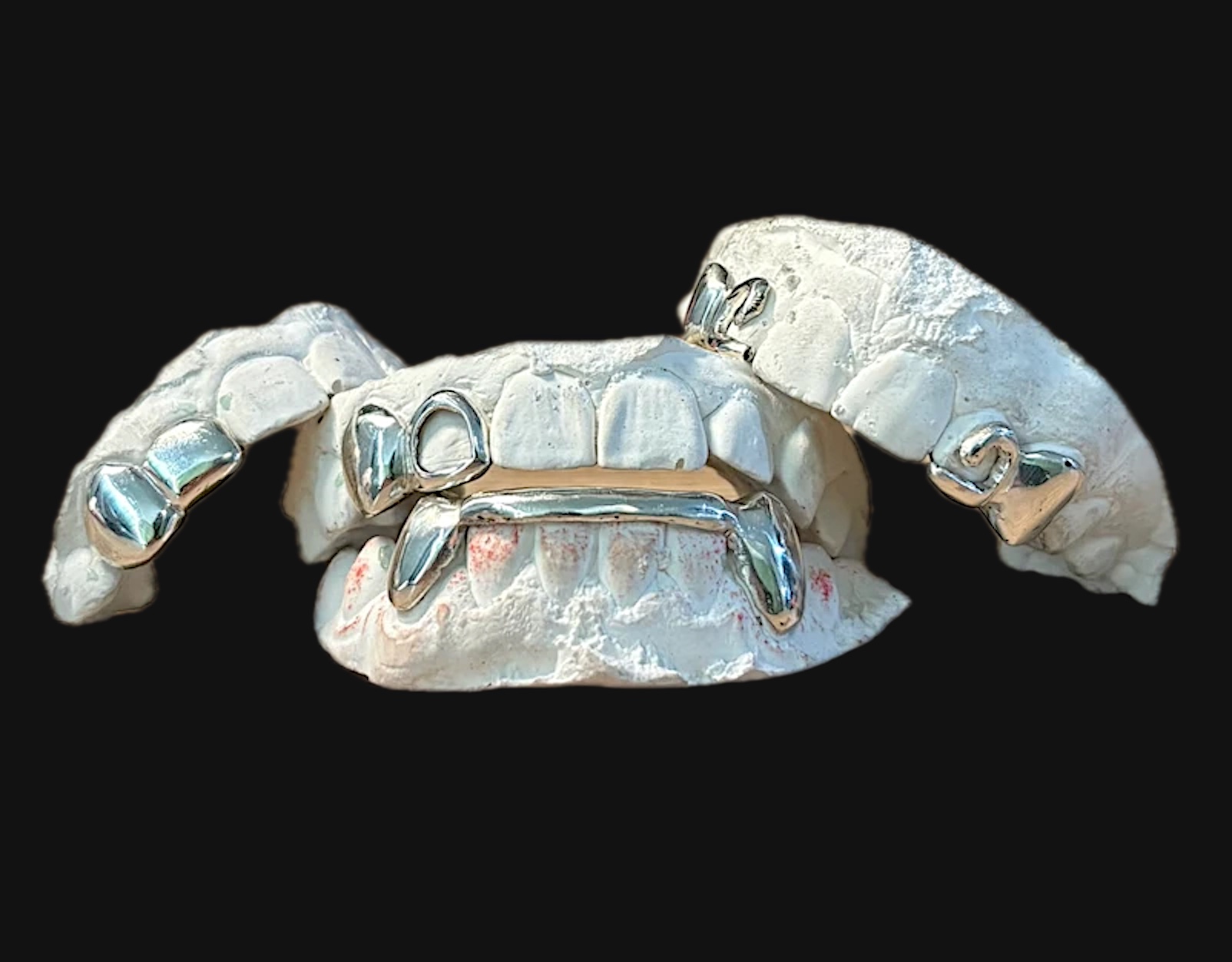 Grillz en argent sur moulages dentaires : open face, fangs et barre